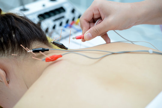 Electro Acupuncture 1