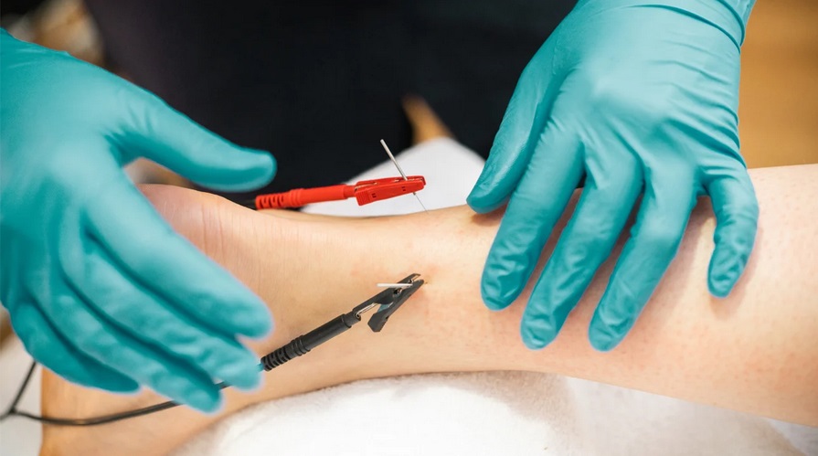 Electro Acupuncture 2