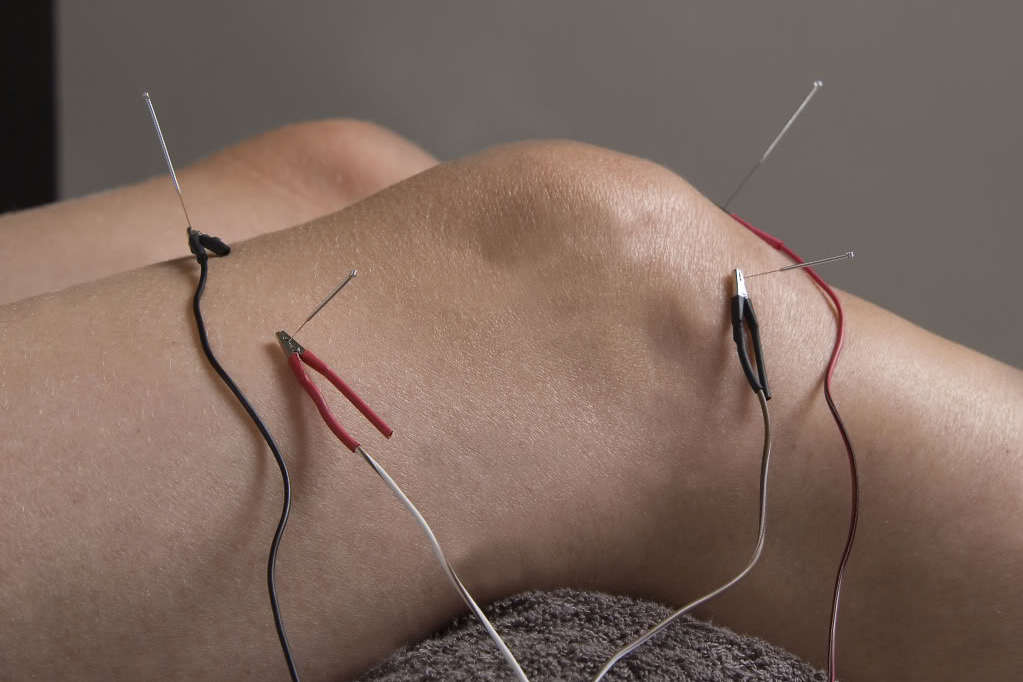 Electro Acupuncture 3