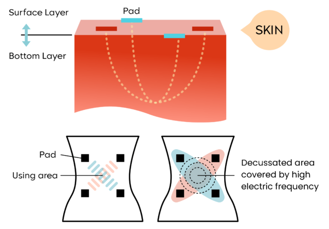 Interferential Current Therapy 1