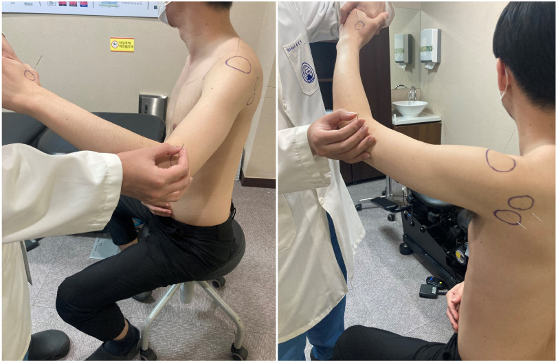 Motion Acupuncture 2